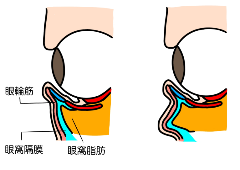 眼窩脂肪