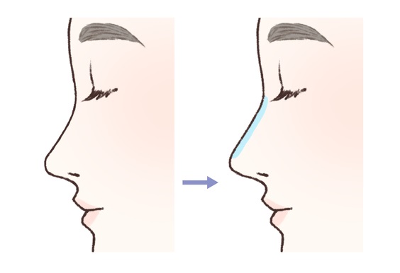 鼻プロテーゼ（隆鼻術）