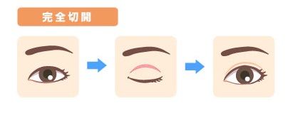 半永久的な二重が叶う「切開法」とは